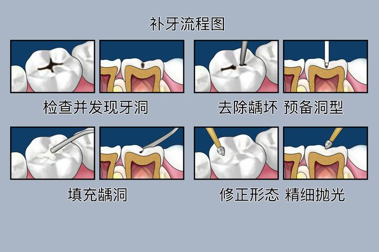 补牙那一种牙齿最好_牙齿种好补牙会疼吗_牙齿种好补牙多少钱