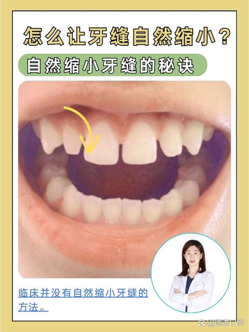 缝隙牙齿矫正门牙变大正常吗_缝隙牙齿矫正门牙变大怎么回事_矫正牙齿门牙缝隙咋变大了