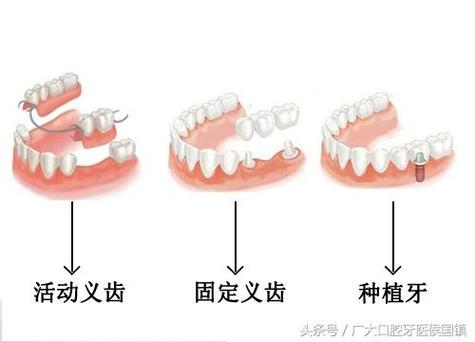 北京种牙失败修复多少钱？游离体取出需花费多少？