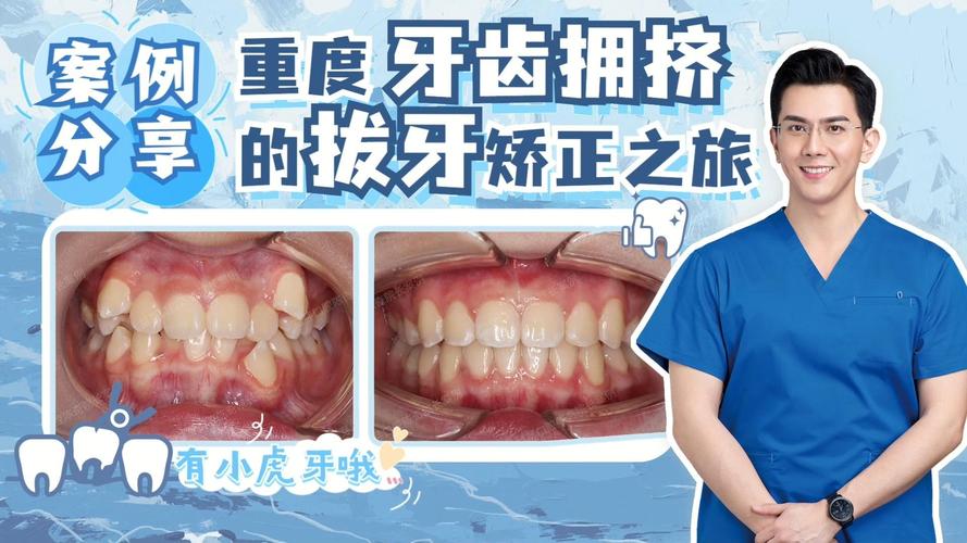 告别“虎牙”尴尬，快速矫正重塑自信笑容