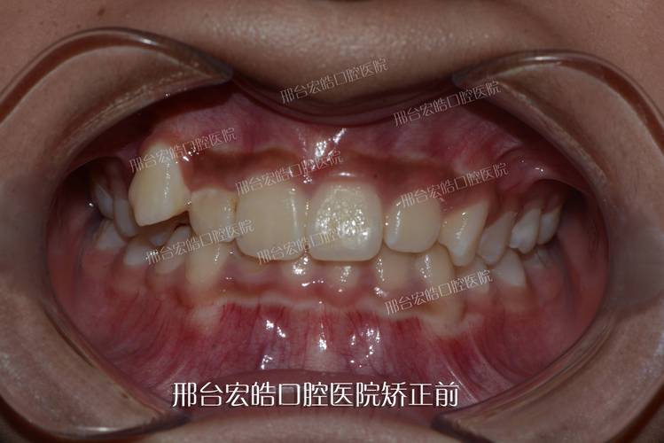 牙齿矫正虎牙多久能拉下来_虎牙快速牙齿矫正_牙齿矫正虎牙快速矫正方法