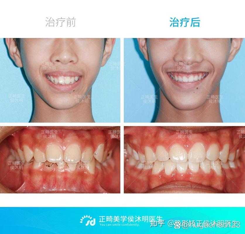 25岁龅牙还能矫正吗？过来人分享真实经历