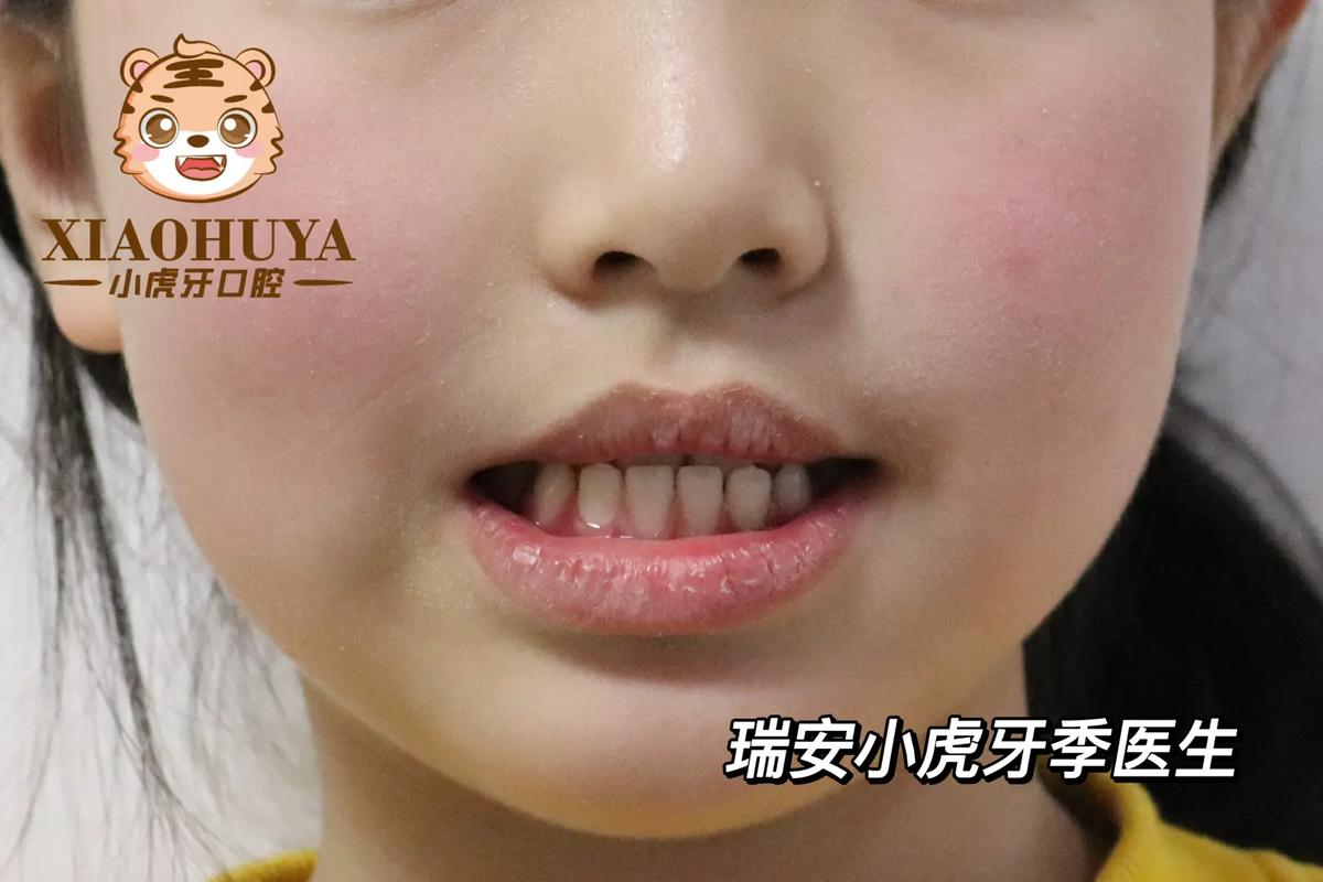 儿童矫正地包天费用_幼儿地包天矫正收费_幼儿矫正地包天多少钱