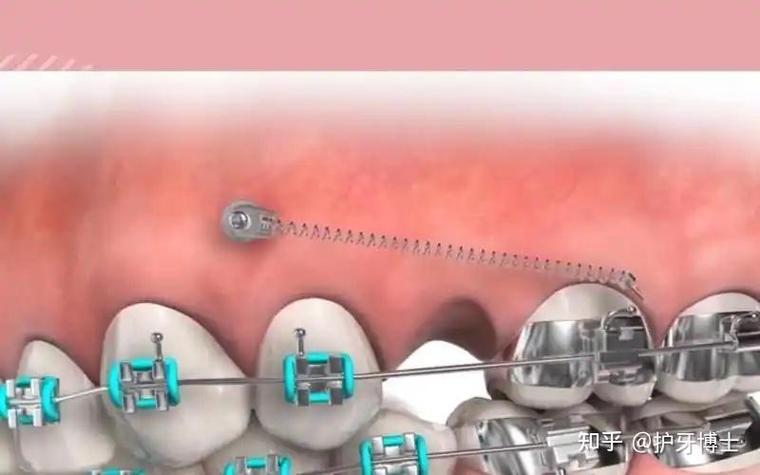 深圳正畸哪家医院好_深圳牙齿正畸医院_深圳骨性龅牙正畸哪家医院靠谱