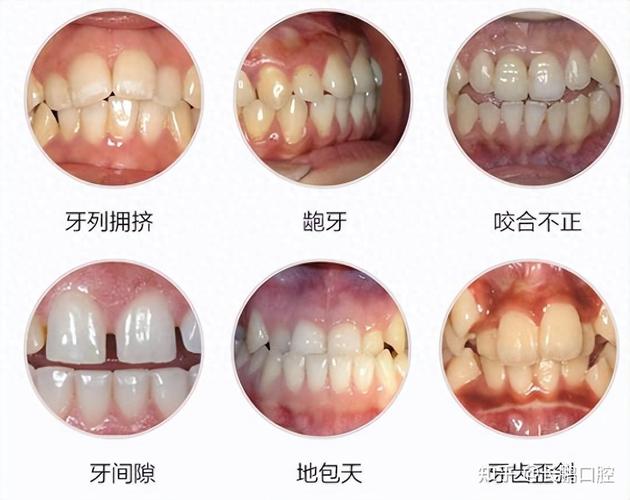 矫正牙错位儿童医院推荐哪家_儿童牙错位矫正医院推荐_儿童医院正畸