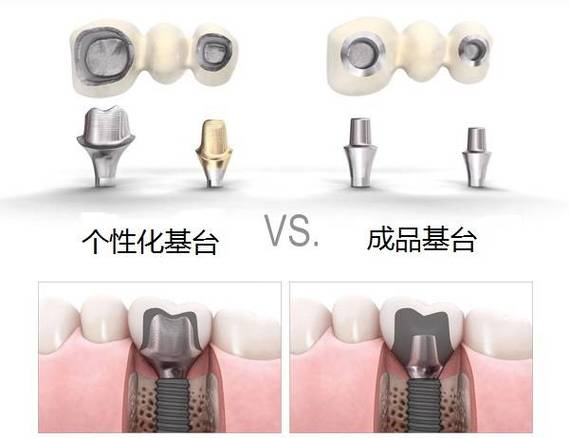 缺牙后选进口还是国产种植体？到底哪个更划算？