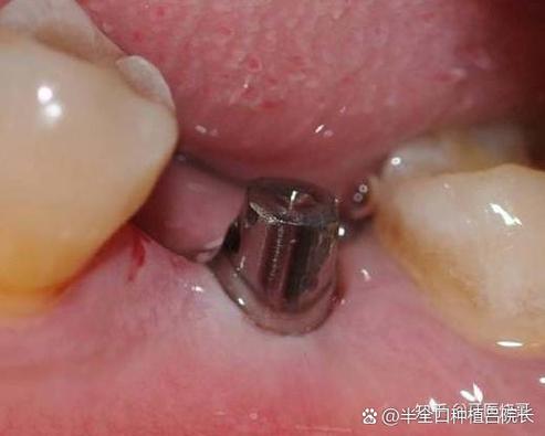 深圳罗湖骨量少做全口种植牙到底要花多少钱