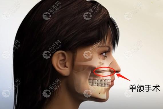 深圳成人骨性龅牙矫正到底要花多少钱？