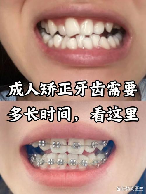 牙齿矫正可以只矫正几颗吗_18岁还可以矫正牙齿_牙齿矫正可以只做上排牙吗