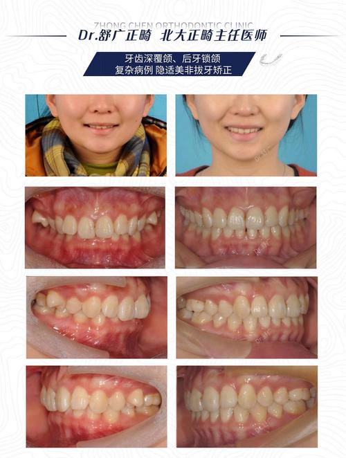 30岁后矫正深覆合？成人正畸完全可行