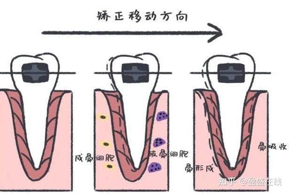 来得及牙齿矫正要多少钱_23岁牙齿矫正还来得及吗_牙齿矫正技术要求高吗