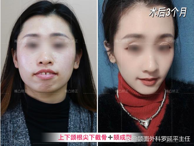 矫正牙齿能治好凸嘴吗_矫正牙齿可以改善凸嘴吗_牙齿矫正能改善凸嘴吗