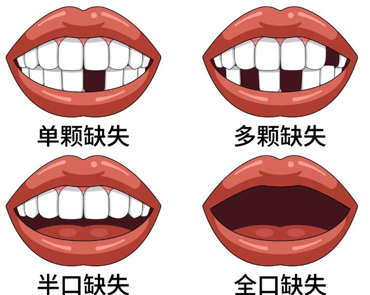 种牙和装烤瓷牙哪个好_种植牙好还是烤瓷好_假牙种植牙烤瓷牙哪个好