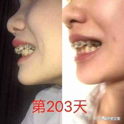 吉林牙齿矫正贵吗_吉林牙齿矫正哪里好一点_吉林矫正牙齿哪家医院好