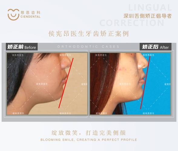 为什么24岁做牙齿矫正效果更好