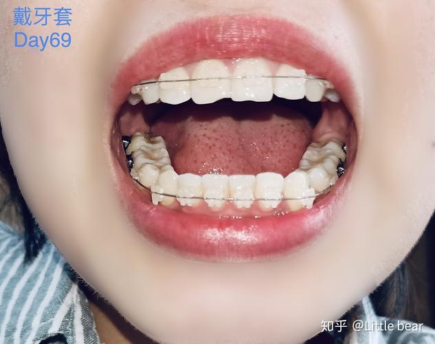 牙齿矫正时机_牙齿矫正技术要求高吗_24岁牙齿矫正还来得及吗