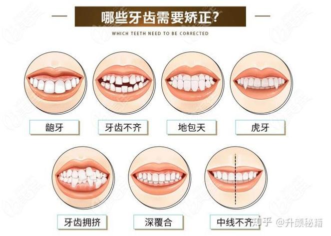 牙齿矫正时机_24岁牙齿矫正还来得及吗_牙齿矫正技术要求高吗