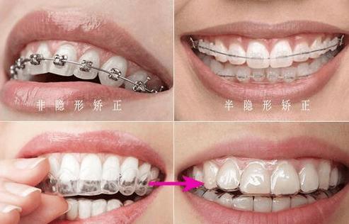 30多岁还能矫正牙齿吗？过来人真实经验分享