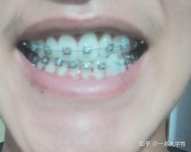 牙齿矫正后会有遗症吗_13岁牙齿矫正的后遗症有哪些_牙齿矫正后遗症有多可怕