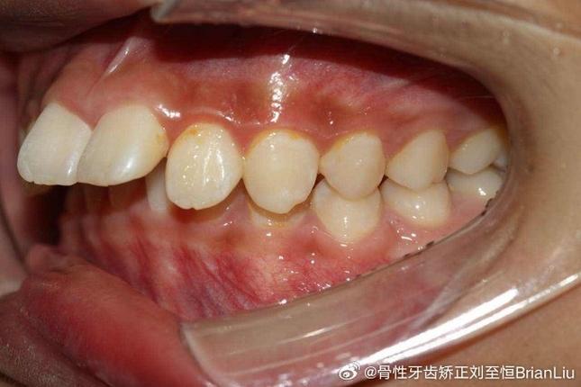 牙齿矫正后遗症有多可怕_牙齿矫正后会有遗症吗_13岁牙齿矫正的后遗症有哪些