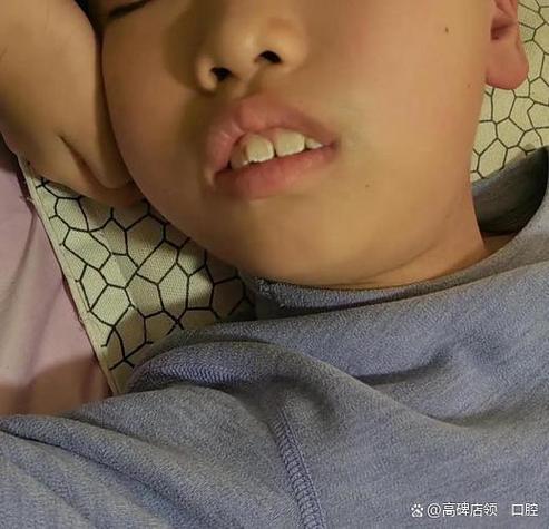 儿童矫正龅牙多少钱_12岁儿童龅牙矫正费用_儿童龅牙矫正