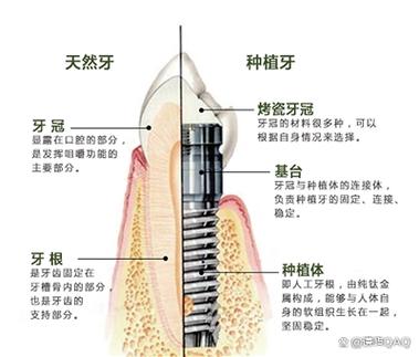 深圳缺牙修复：镶牙与种植牙到底哪个更省钱？
