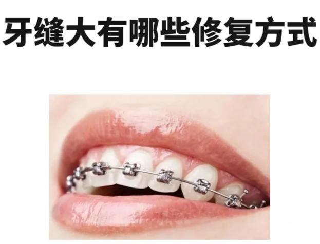 牙齿矫正深圳_成人牙缝矫正大概要花费多少钱_深圳成年人牙缝大矫正方案