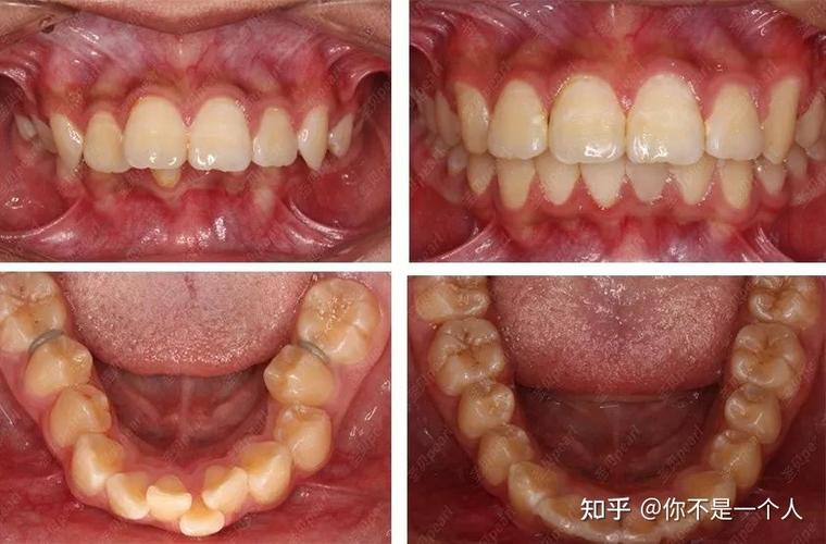 27岁整牙晚不晚？揭秘成年正畸的真实效果与风险
