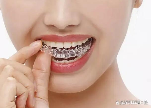 深圳隐适美矫正大概多少钱_深圳隐形牙齿矫正价格_深圳福田隐形正畸收费标准