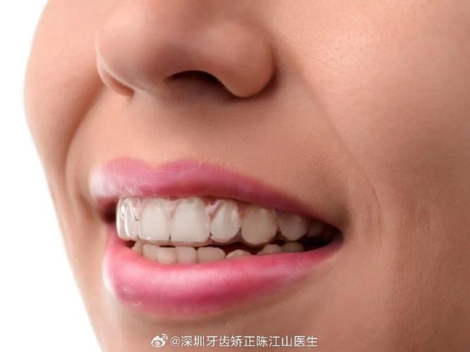 成年人矫正牙齿多久能好？揭秘快速整牙的真相与代价