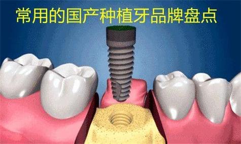 深圳百康特种牙多少钱一颗？真实价格内幕揭秘