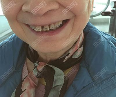牙齿矫正可以刷医保卡吗_牙齿矫正可以只做上排牙吗_30多岁可以矫正牙齿么