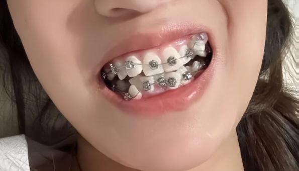 矫正牙可以只做上面一排吗_可以单独矫正一颗牙吗_矫正牙可以不拔牙吗