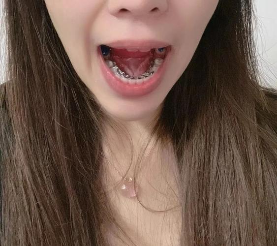 儿童牙齿矫正一般价格_儿童牙齿矫正包含哪些收费项目_牙齿矫正儿童多少钱