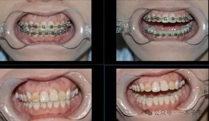 30岁矫正牙齿有什么危害？把坑说透了再决定