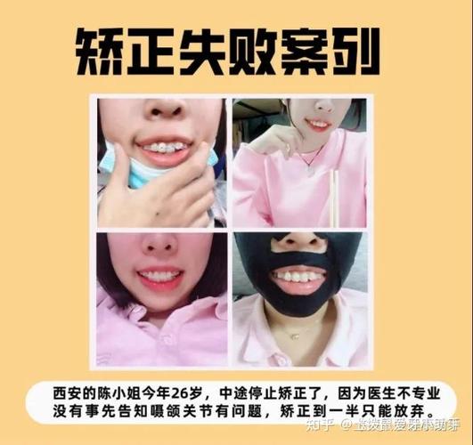 28岁矫正牙齿还来得及吗？我的经历和答案