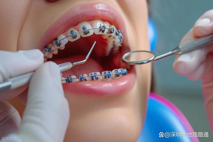 成人牙齿矫正好还是矫正_成人牙齿矫正好不好_哪里矫正成人牙齿好