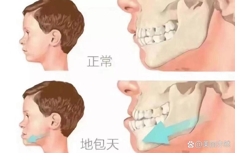 儿童地包天矫正医院_深圳治疗地包天哪家医院好_深圳儿童地包天最佳矫正年龄