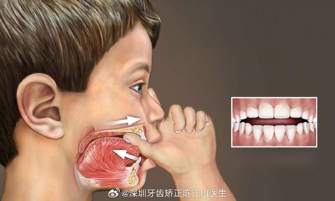 深圳孩子地包天几岁治最好？牙医揭秘黄金期