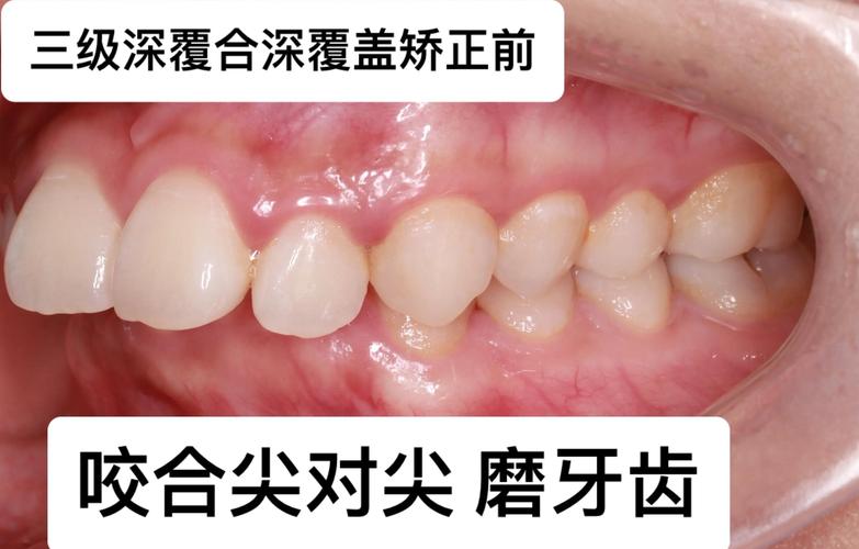 正畸期间可以怀孕吗_正畸过程可以洗牙吗_26岁还可以做牙齿正畸吗
