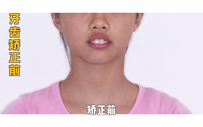 11岁可以矫正牙齿吗_牙齿矫正可以只做上排牙吗_牙齿矫正可以改变脸型吗