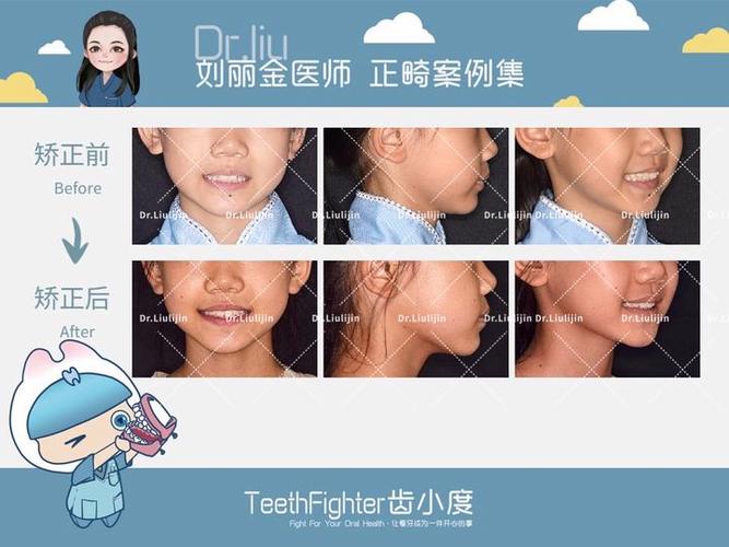 11岁可以矫正牙齿吗_牙齿矫正可以只做上排牙吗_牙齿矫正可以改变脸型吗