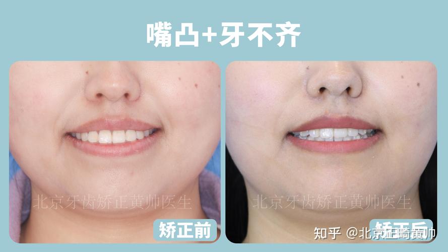 矫正牙齿有年龄_牙齿矫正年龄大了会松动吗_牙齿矫正年龄多少合适