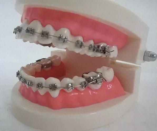 35岁矫正牙齿还来得及吗？真实体验告诉你