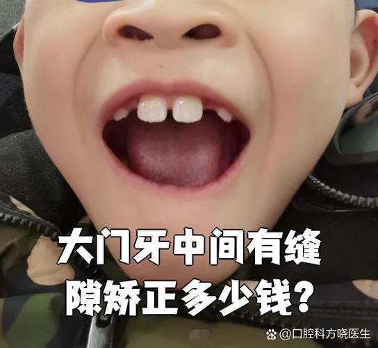 纠正牙型大概多少钱一共_纠正牙型有几种方法_纠正牙型价钱