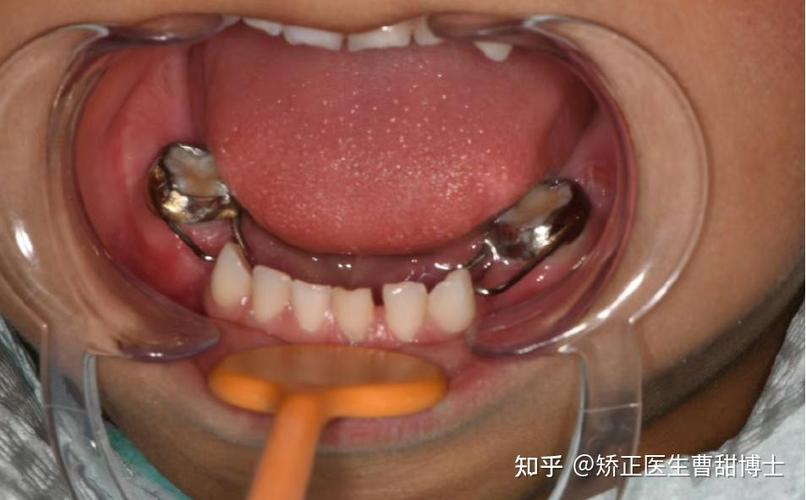 9岁小孩牙齿正畸_小孩正畸的最佳年龄_孩子牙齿正畸