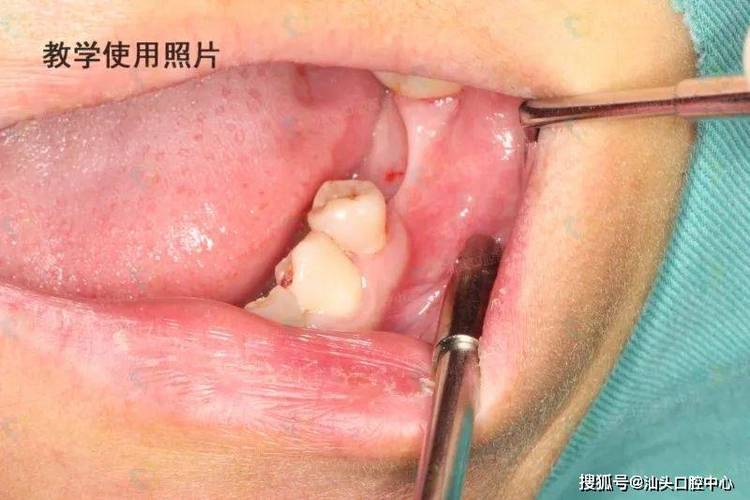 没牙骨能种牙吗_种牙没骨头还能种吗_没有牙骨可以种牙吗