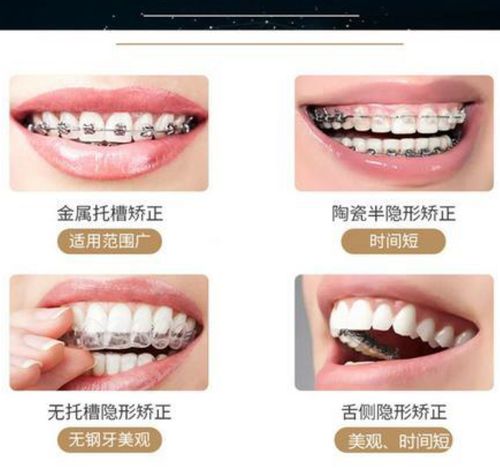 25岁矫正牙齿可以么_牙齿矫正可以改变脸型吗_牙齿矫正可以只做上排牙吗