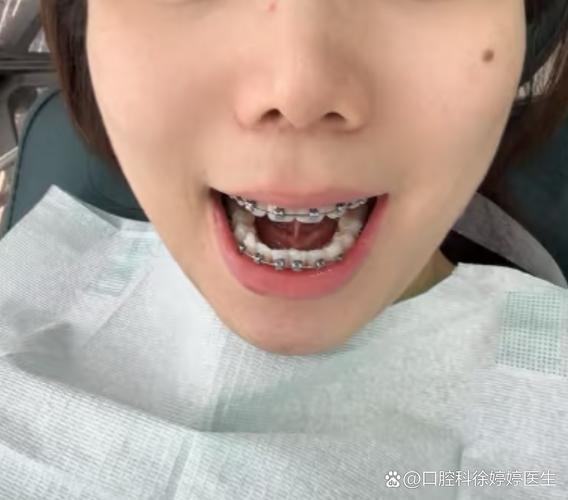 25岁矫正牙齿可以么_牙齿矫正可以只做上排牙吗_牙齿矫正可以改变脸型吗