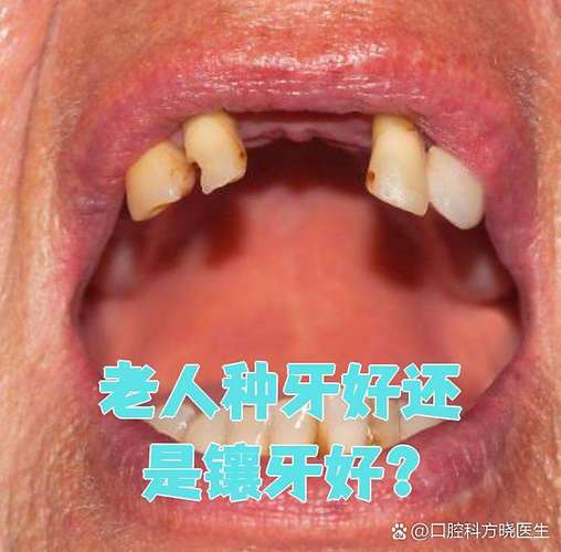 74岁老人种牙晚不晚？医生揭秘高龄种植的真实风险与收益